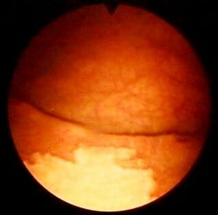Фото лейкоплакии мочевого пузыря