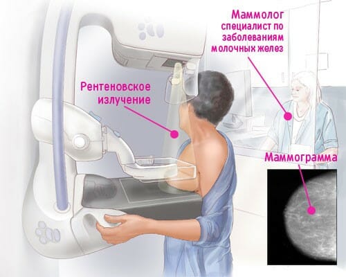 Маммография и рентгеновское излучение