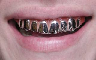 Металлические коронки на всех зубах