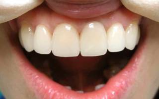 Металлокерамика на передних зубах