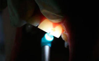 Диагностика зубов с помощью просвечивания
