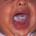 Молочница (кандидоз) у ребенка во рту