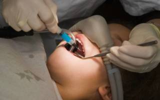 Общий наркоз в стоматологии