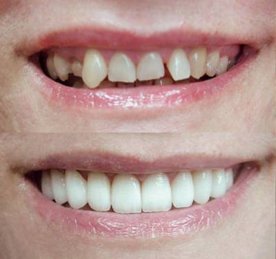 Непрямая реставрация передних зубов