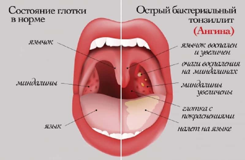 Нормальное горло и тонзиллит