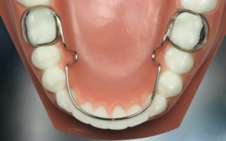 Охватывающие ретейнеры на зубы