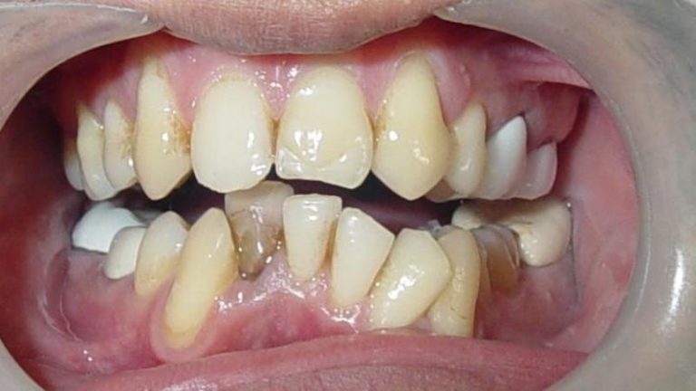 Оклюзия зубов