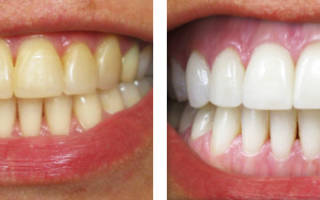 Отбеливание зубов методом Opalescense