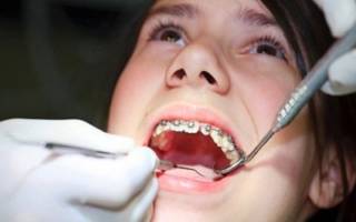 Девочка у ортодонта