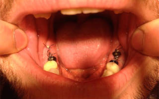 Операция по имплантации зубов