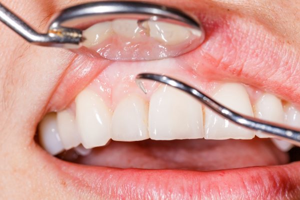 Осмотр зубов у стоматолога