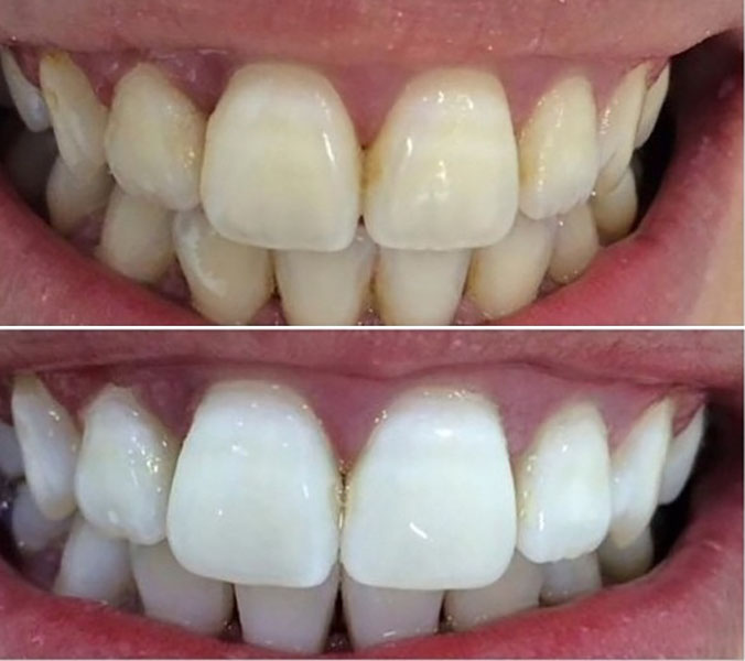 Отбеливание зубов - до и после процедуры
