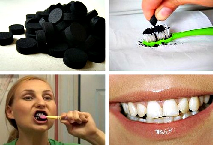Этапы отбеливания зубов