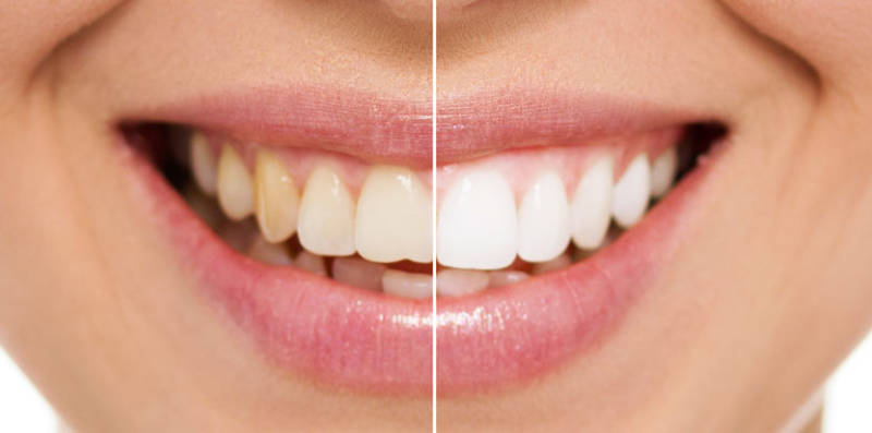 Фото зубов девушки до и после процедуры