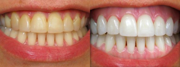 Чистка зубов Аир флоу - до и после