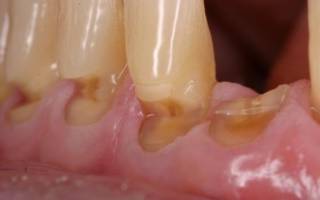 Отломленный зуб при клиновидном эффекте