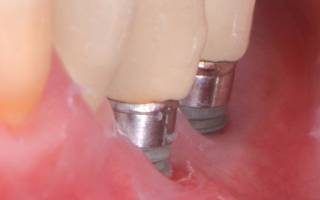 Отторжение имплантов зубов
