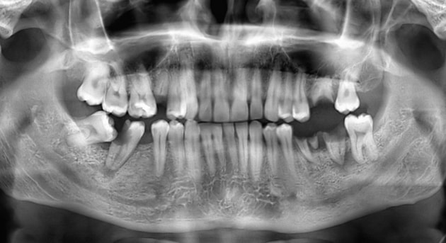 Вид панорамного снимка зубов