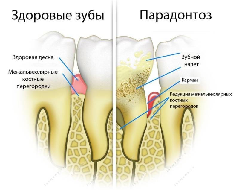 Пародонтоз и здоровые зубы