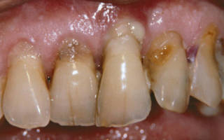 Оголение зубов