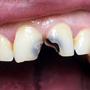 Кариозные передние зубы