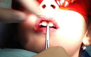 Коррекция уздечки верхней губы