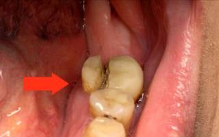 Травма жевательного зуба