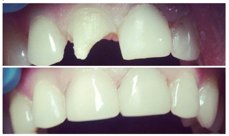 Пломба на передние зубы до и после
