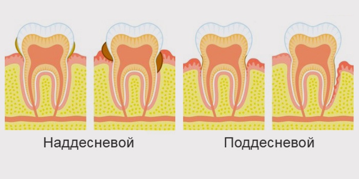Виды зубного камня