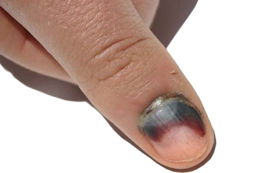 палец с раком ногтя