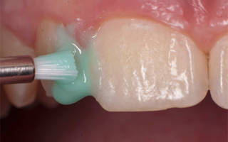 Нанесение фторлака на зубы