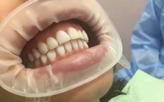 Зубы после чистки