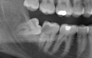 Прицельный снимок зуба
