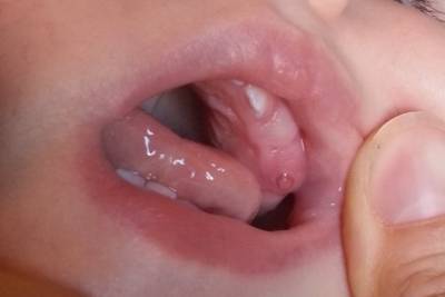 Прорезывание молочного зуба у ребенка