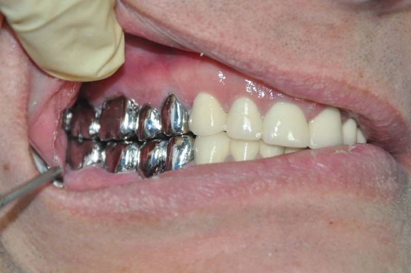 Мостовидный протез жевательных зубов
