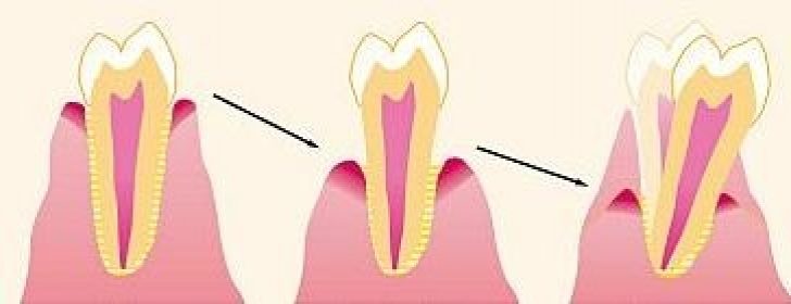 Процесс оголения корня зуба
