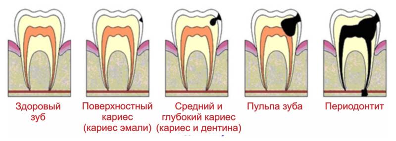 Развитие пульпита в зубе