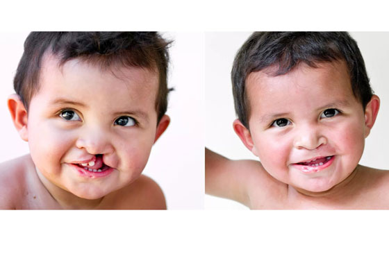 Мальчик до и после операции