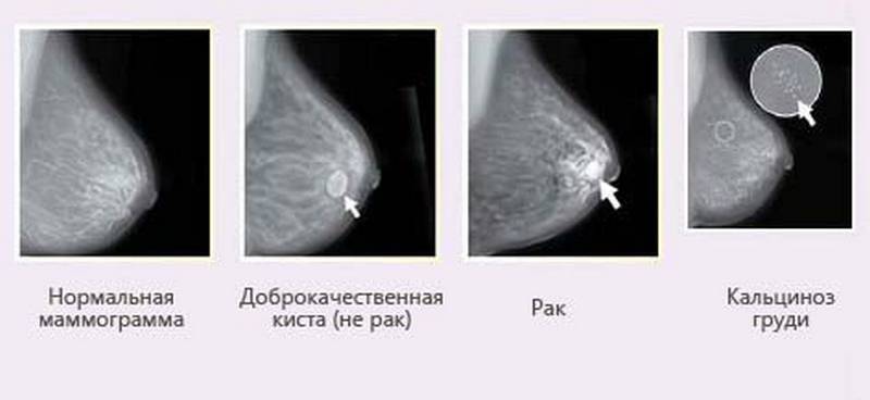 Снимки маммограммы
