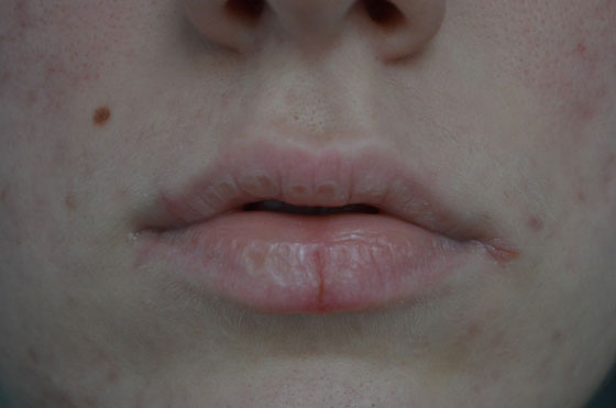 рассечение губы