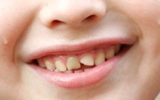 трещины на зубах у ребенка