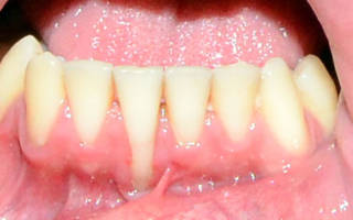 Оголение шейки зуба