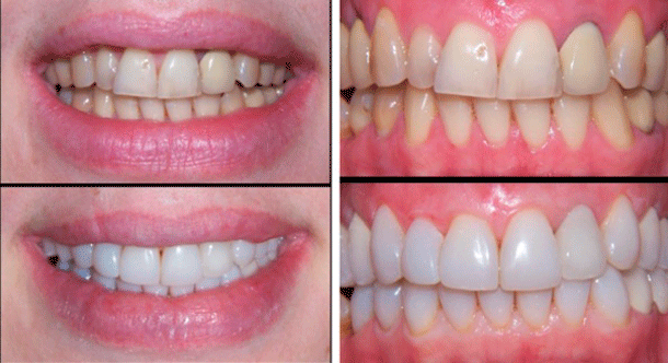 Реставрация зубов - до и после