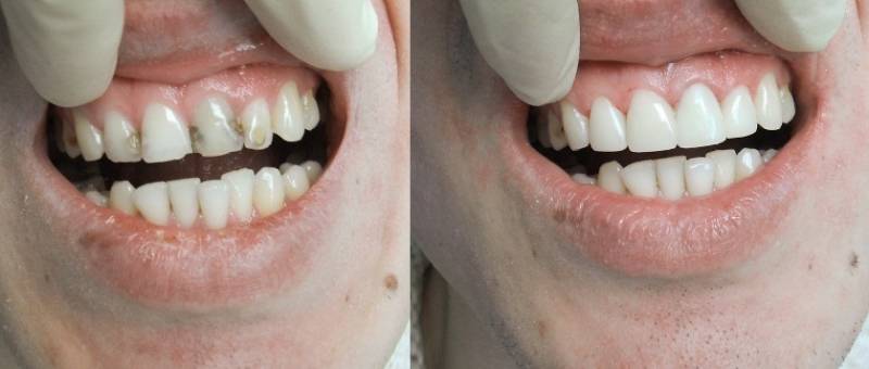 Реставрация зубов - фото до и после