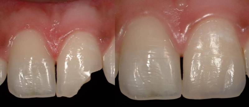 До и после реставрации зубов