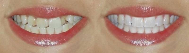 До и после художественной реставрации зубов