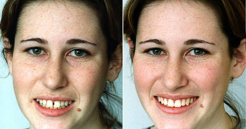 До и после лечения щели между передними зубами