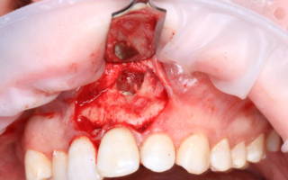 Операция по удалению верхушки корня зуба