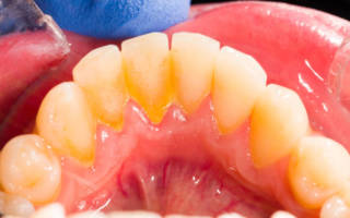 Желтый налет на передней поверхности зубов