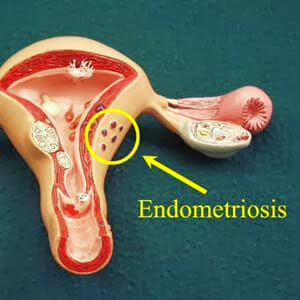 Макет матки и эндометриоз